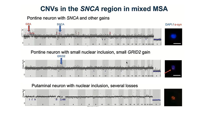 Somatic CNV detection by single-cell whole-genome sequencing in multiple system atrophy, a sporadic neurodegenerative disorder
